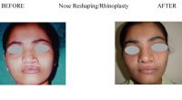 1-Nose-Reshaping-Rhinoplasty-6-1