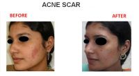 Acne-Scar-2