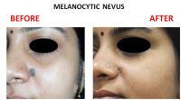 Melanocytic-Nevus-2