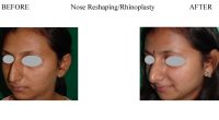 Nose-Reshaping-Rhinoplasty-3-1