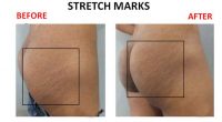 Stretch-Marks-7