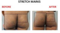 Stretch-Marks-8