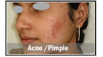 acne-pimple