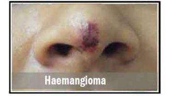 haemangioma