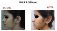 mole-removal-11