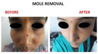 mole-removal-3