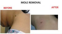 mole-removal-9
