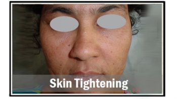 skin-tightening-1