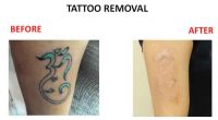 tatto-removal8