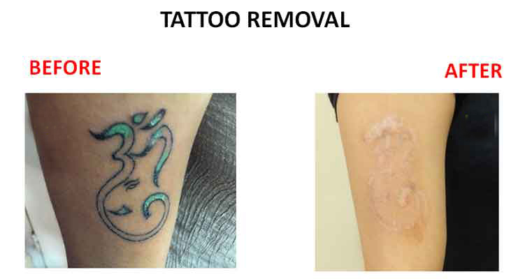 Laser Tattoo Removal Price  DrK Prem Anand  Painless Tattoo Removal In  Bangalore India  YouTube