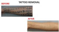 tatto-removal9