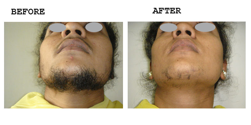 Chin & front of neck hair removal Photo – Amrit Clinic