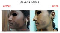 beckers-nevus-3