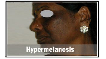 hypermelanosis