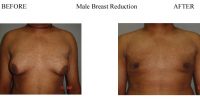1-Male-Breast-Reduction-4