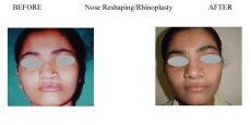 1-Nose-Reshaping-Rhinoplasty-6