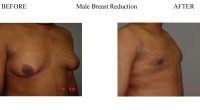 2-Male-Breast-Reduction-5