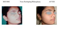 2-Nose-Reshaping-Rhinoplasty-7