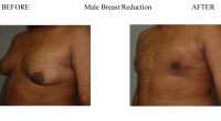3-Male-Breast-Reduction-6