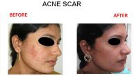 Acne-Scar-1