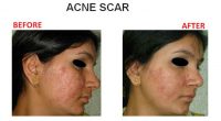 Acne-Scar-5