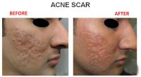Acne-Scar-7