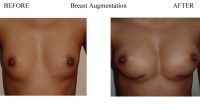 Breast-Augmentation-1