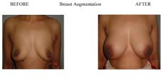 Breast-Augmentation-10