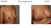 Breast-Augmentation-11