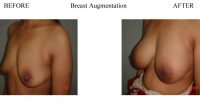 Breast-Augmentation-12