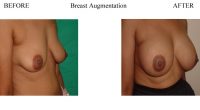 Breast-Augmentation-14