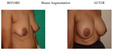 Breast-Augmentation-14