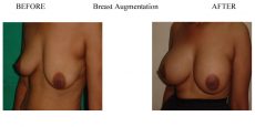Breast-Augmentation-15