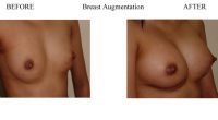Breast-Augmentation-2