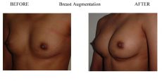 Breast-Augmentation surgery