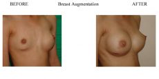 Breast-Augmentation-5
