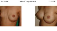 Breast-Augmentation-6