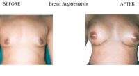Breast-Augmentation-7