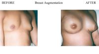 Breast-Augmentation-8