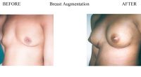 Breast-Augmentation-9