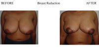 Breast-Reduction-1
