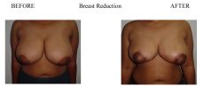 Breast-Reduction-1