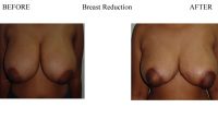 Breast-Reduction-2