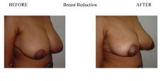 Breast-Reduction-3