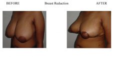 Breast-Reduction-4