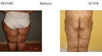 Buttocks-1
