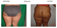 Buttocks-2