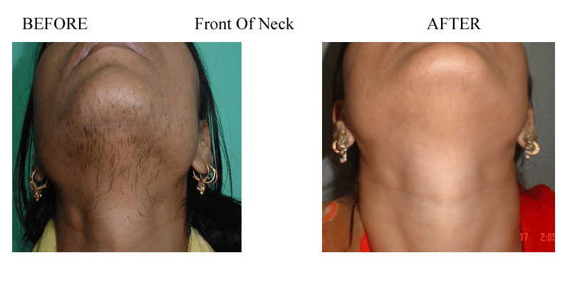 Chin & front of neck hair removal Photo – Amrit Clinic