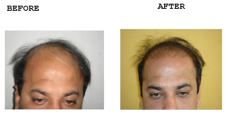Hair Transplant – Amrit Clinic