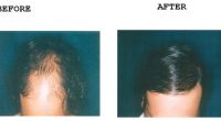 Hair-Transplant-4